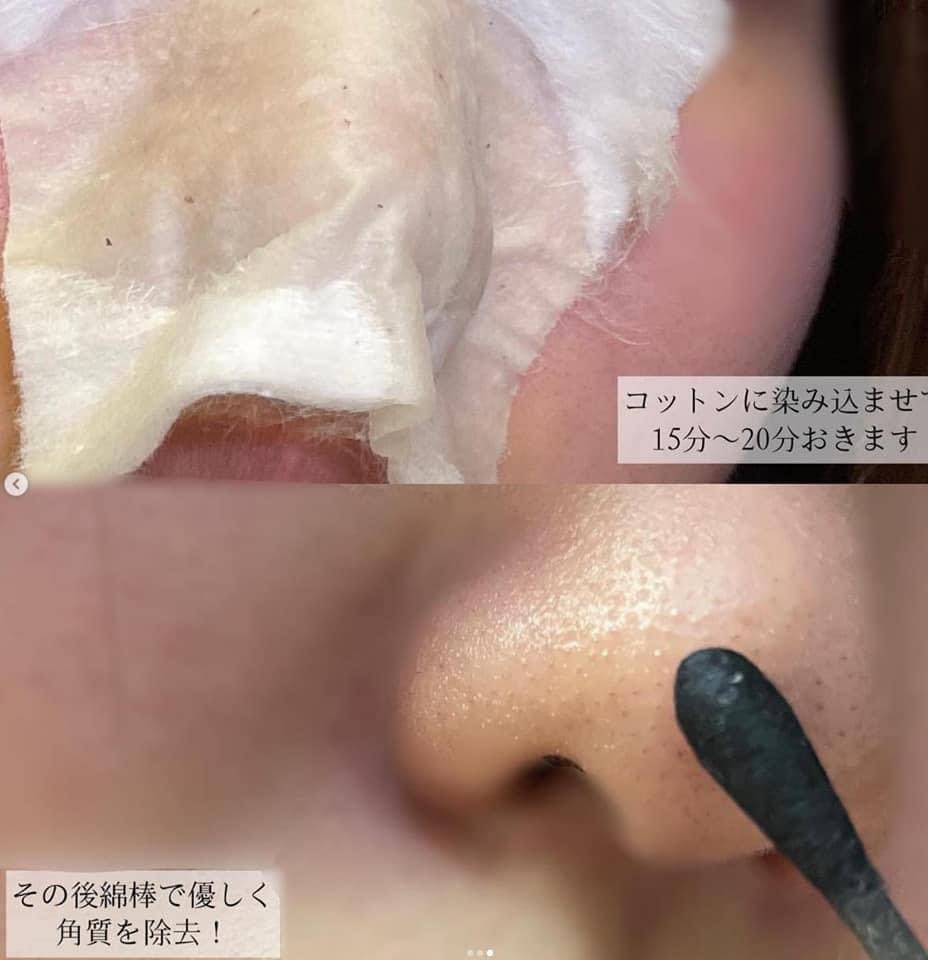 One-day's you - P.Z Ssoc Ssoc No More Blackhead