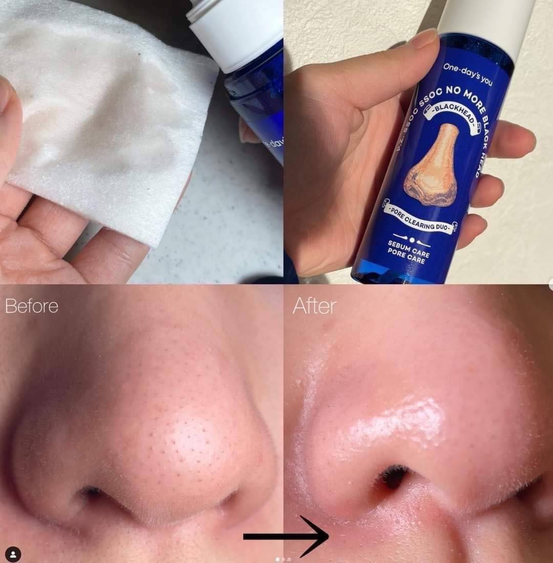 One-day's you - P.Z Ssoc Ssoc No More Blackhead