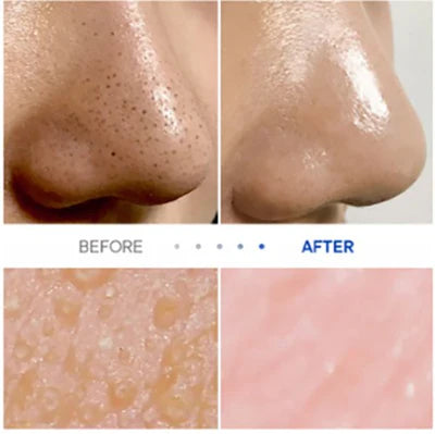 One-day's you - P.Z Ssoc Ssoc No More Blackhead