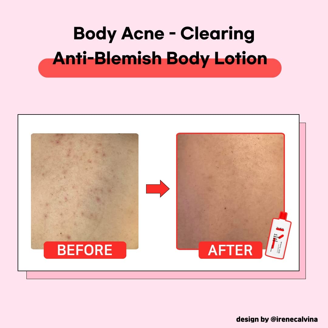 TIA'M - Anti Blemish Body Lotion Back & Chest