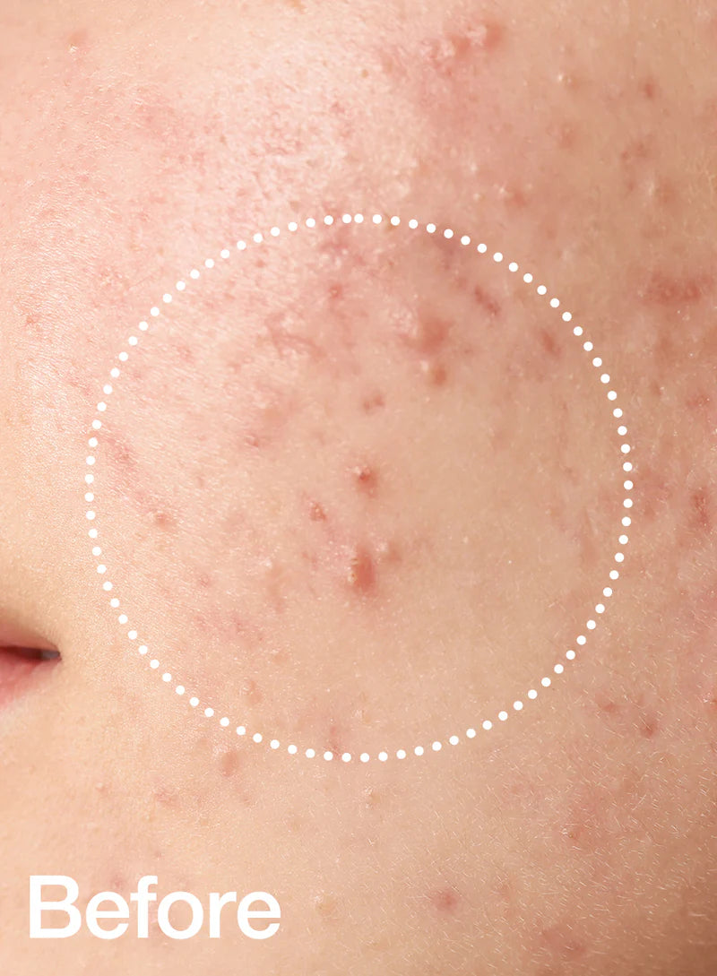 Anua - BHA 2% Gentle Exfoliating Toner