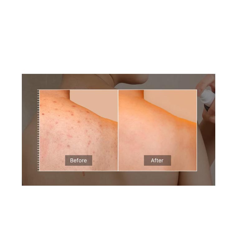 medicube - Red Acne Body Peeling Shot